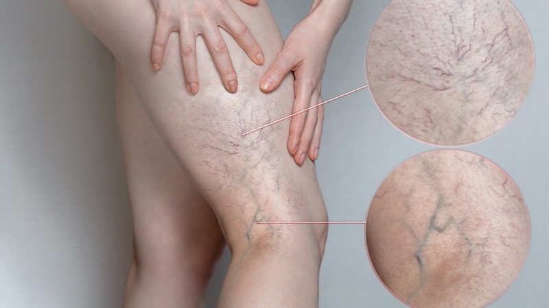 DẤU HIỆU SUY GIÃN TĨNH MẠCH