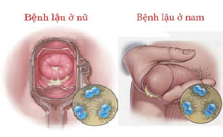 Bệnh Lậu: Nguyên Nhân, Triệu Chứng, Chẩn Đoán, Điều Trị và Phòng Ngừa
