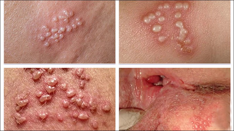 11 Bệnh Lây Qua Đường Tình Dục Phổ Biến: Triệu Chứng, Biến Chứng và Phòng Ngừa