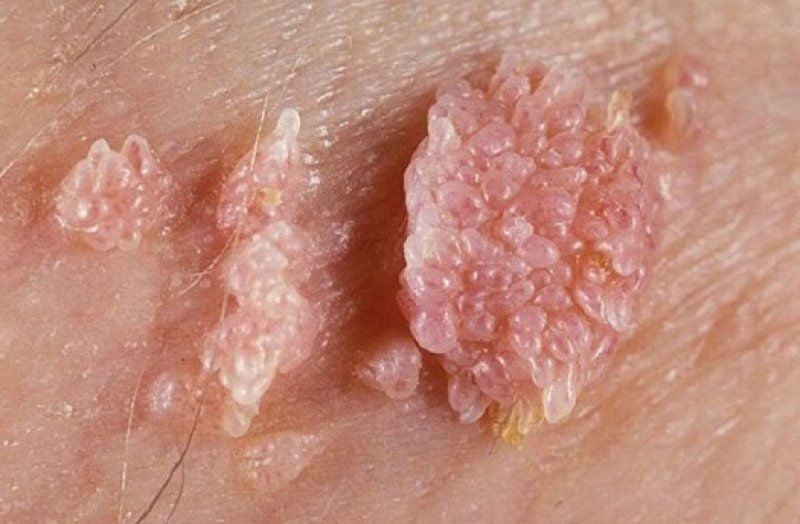 Sùi mào gà: Nguyên nhân, Triệu chứng và Giải pháp Điều trị