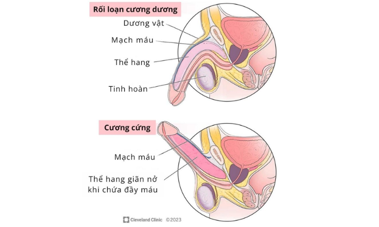 Làm sao để biết bạn đã bị rối loạn cương dương?
