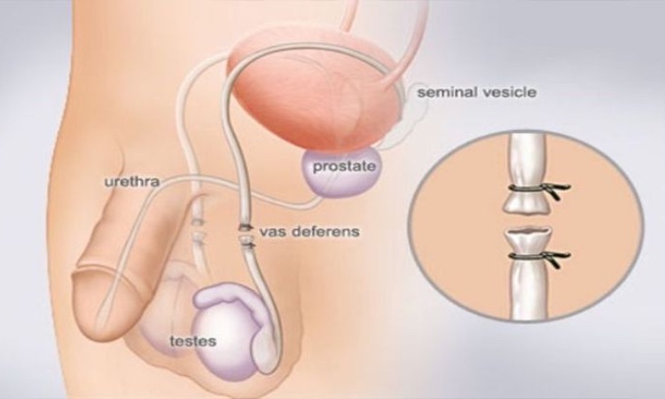 Thắt ống dẫn tinh có làm giảm ham muốn không?