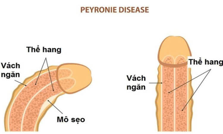 Tất tần tật về bệnh lý cong dương vật