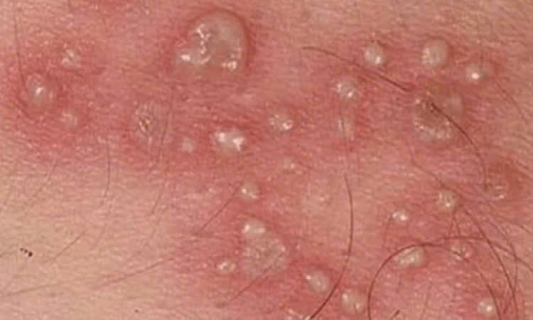 Tất tần tật về hạt fordyce