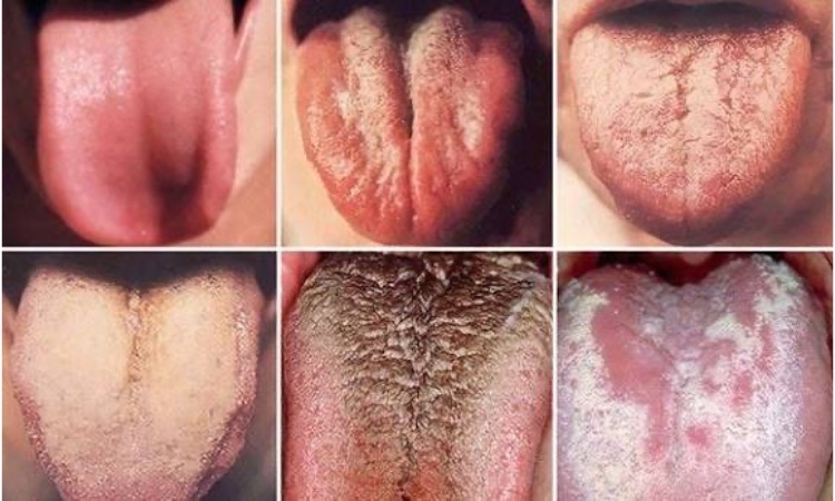 Vai trò của xem lưỡi trong chẩn đoán yếu sinh lý