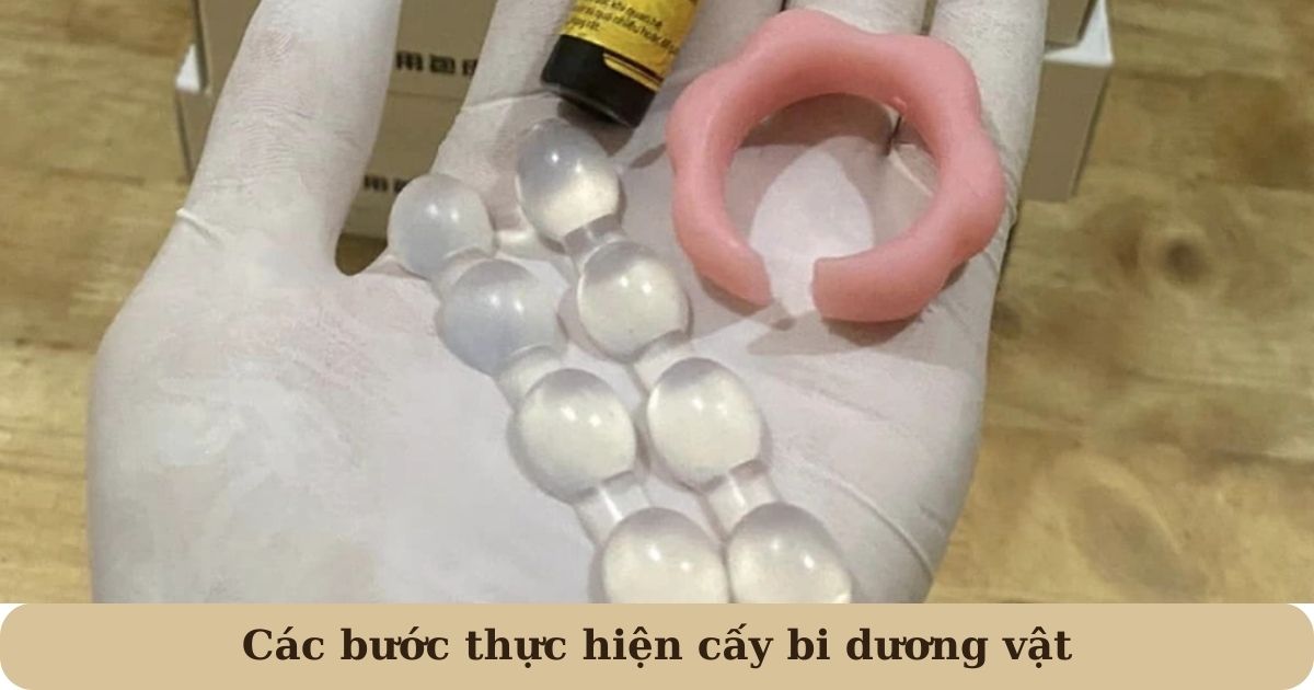 Các bước thực hiện cấy bi dương vật