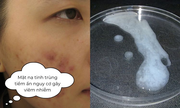Mặt nạ tinh trùng tiềm ẩn nguy cơ gây viêm nhiễm