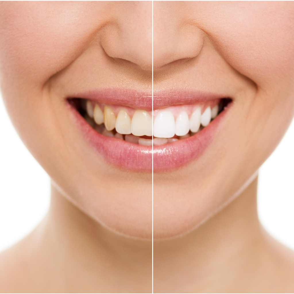 KEM ĐÁNH RĂNG THAN HOẠT TÍNH - TRẮNG BÓNG Red Seal Whitening Toothpaste Activated Charcoal, Paraben Free, 110g