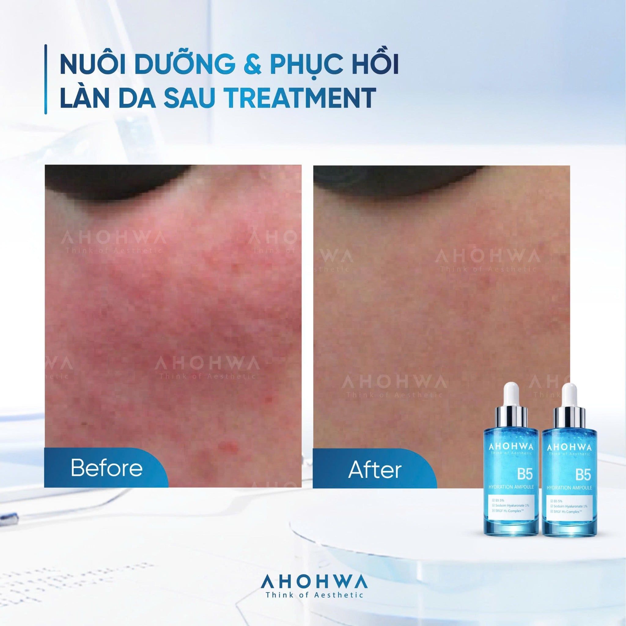 Tinh Chất Ahohwa Hydration Ampoule B5 30ml - Cấp Ẩm, Phục Hồi & Làm Dịu Da