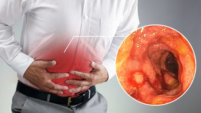 Phân biệt triệu chứng của viêm đại tràng và viêm loét đại tràng