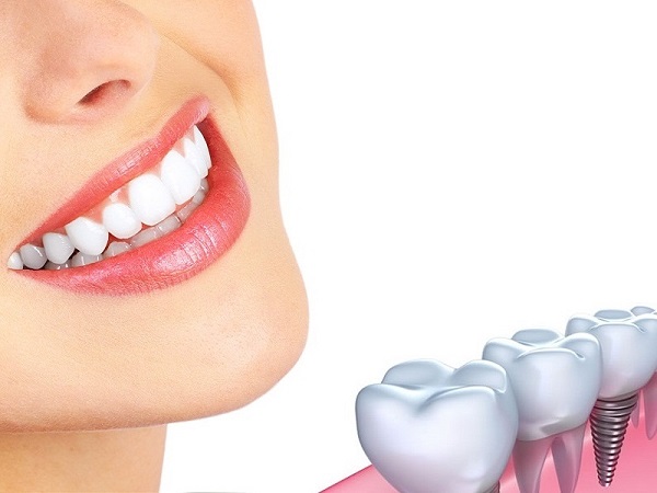 TRỒNG RĂNG IMPLANT Trồng răng implant<br> Ghép xương răng<br>Trồng răng nguyên hàm