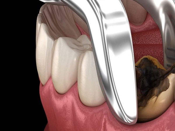 DỊCH VỤ NHỔ RĂNG Nhổ răng khôn<br> Cắt lợi chùm<br>Nhổ răng sữa trẻ em