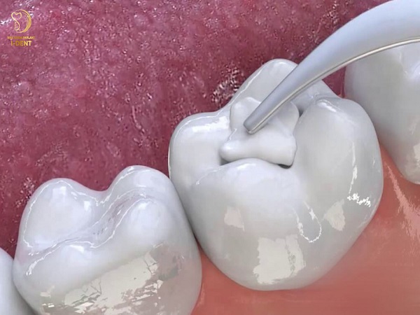 DỊCH VỤ TRÁM RĂNG Phục hồi hình dạng răng<br>Tăng tính thẩm mỹ<br>Giảm ê buốt