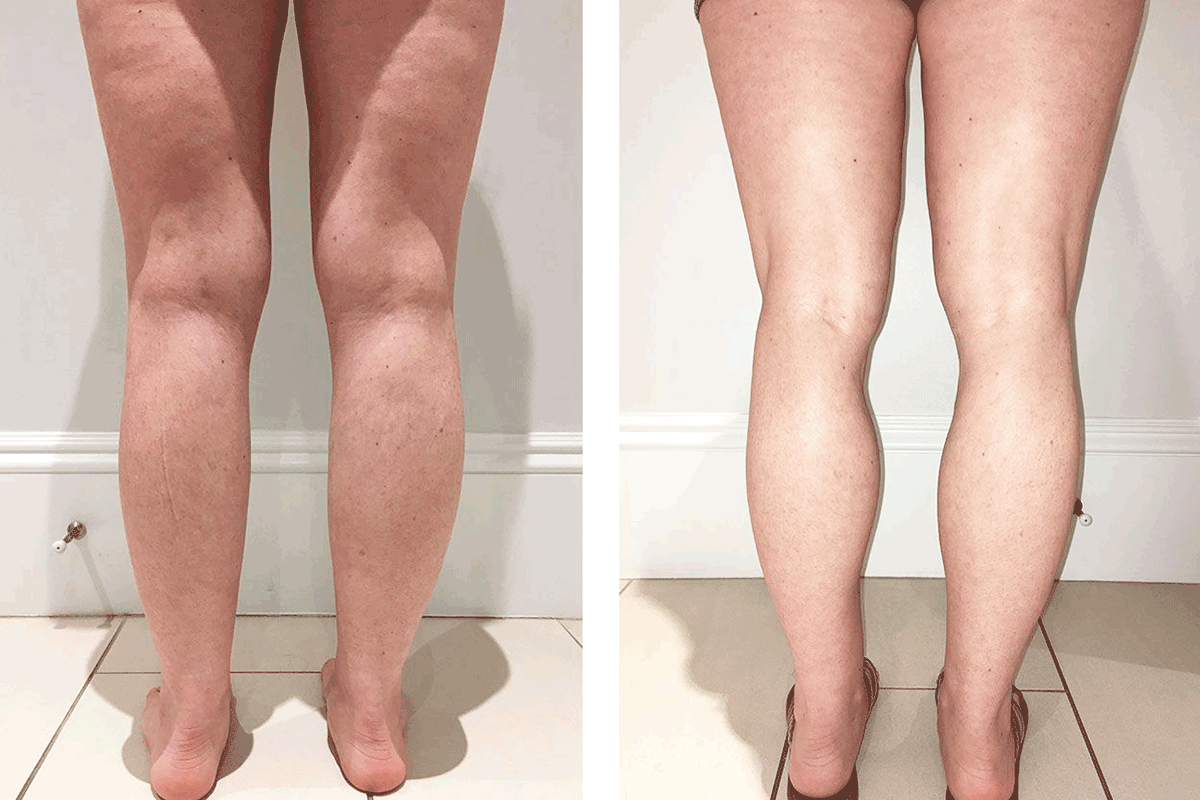 Khám Phá 5 Bài Tập Giúp Bạn Thu Nhỏ Bắp Chân Nhanh Chóng