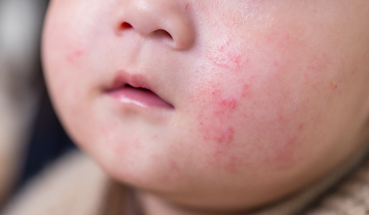 CÁC BỆNH NGOÀI DA MÙA LẠNH THƯỜNG GẶP Ở TRẺ EM: NHẬN BIẾT VÀ CHĂM SÓC ĐÚNG CÁCH