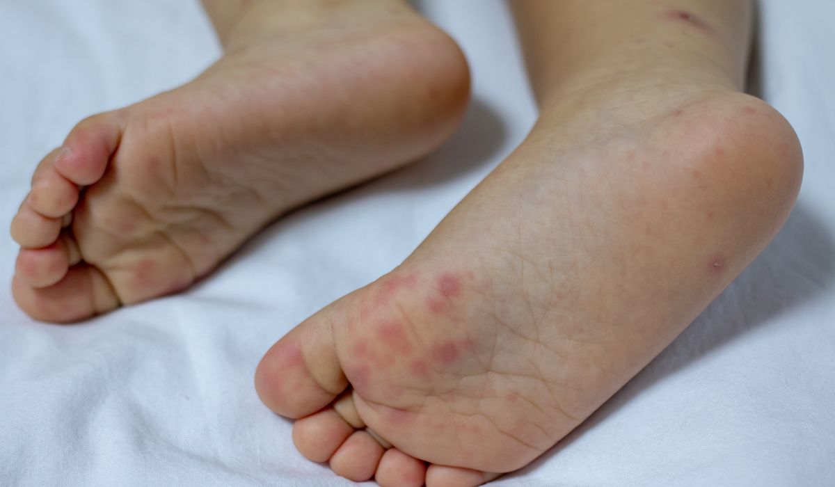 8 BIỆN PHÁP VÀNG PHÒNG CHỐNG VÀ XỬ LÝ BỆNH TAY CHÂN MIỆNG TẠI NHÀ