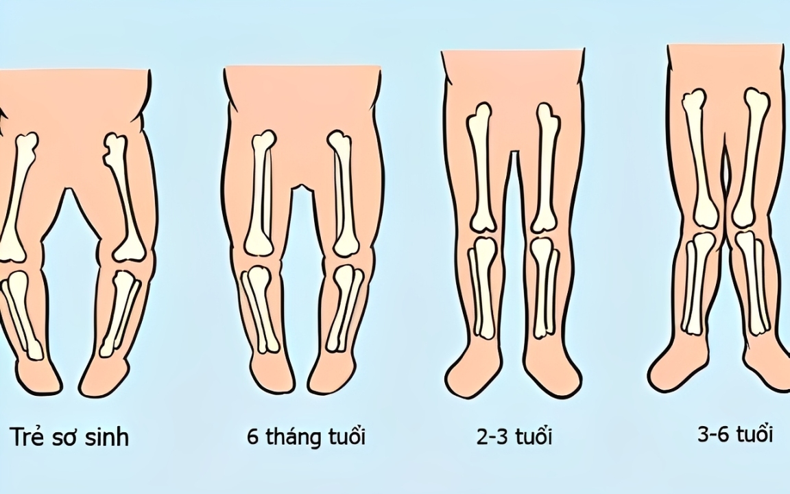 Bàn chân chữ X ở trẻ em: Nguyên nhân, dấu hiệu và cách điều trị hiệu quả