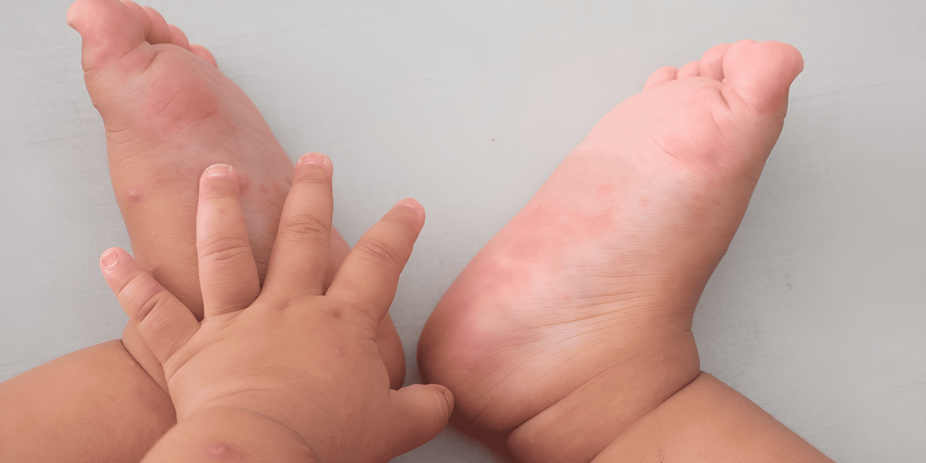 Vì sao chân trẻ bị hôi và nấm ngứa? Sai lầm từ đôi tất ba mẹ cần bỏ ngay!
