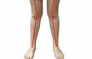 Cách phân biệt chân chữ X sinh lý và bệnh lý ở trẻ - Ba mẹ cần biết!