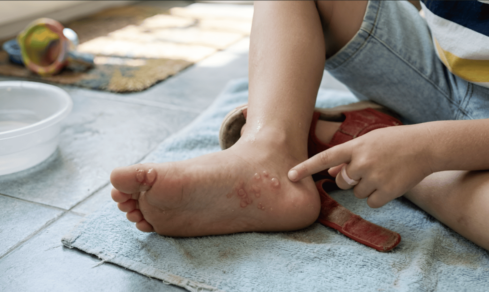 Chân Con Bốc Mùi, Nổi Mụn Nước Ngày Hè: Hiểm Họa Rình Rập Từ Đôi Giày Tập Đi 