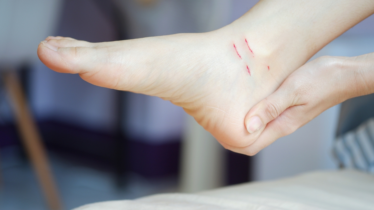 VẾT HẰN ĐỎ Ở CỔ CHÂN BÉ DO ĐI TẤT: ĐỪNG CHỦ QUAN! NGUYÊN NHÂN & KHẮC PHỤC