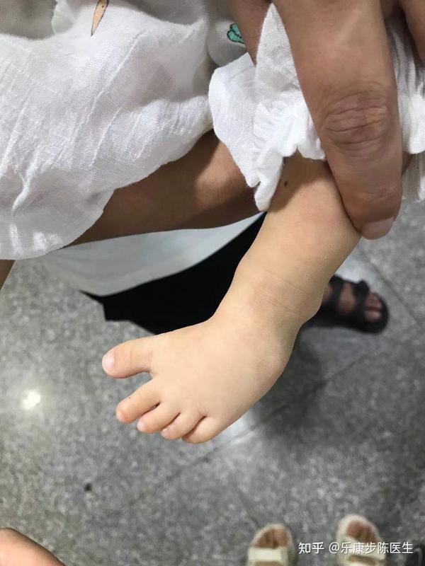 Mẹ nên làm gì khi bé đi bị xoay bàn chân vào trong?