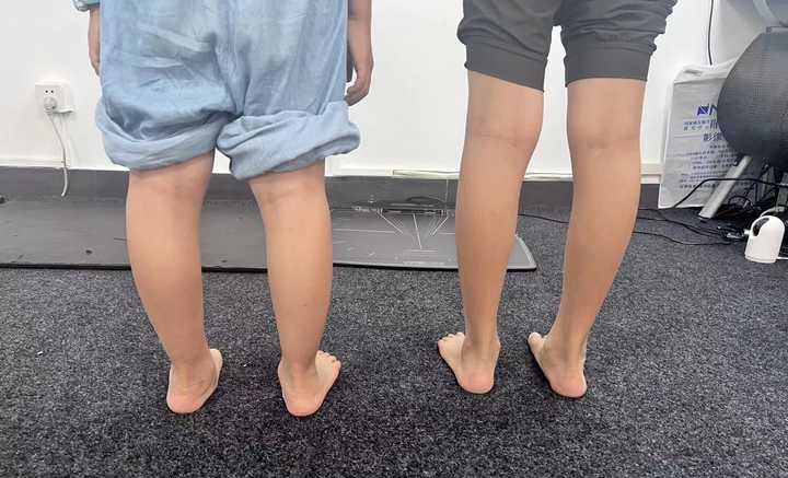 Trẻ bị bàn chân bẹt - Có cần mang giày chỉnh hình không?