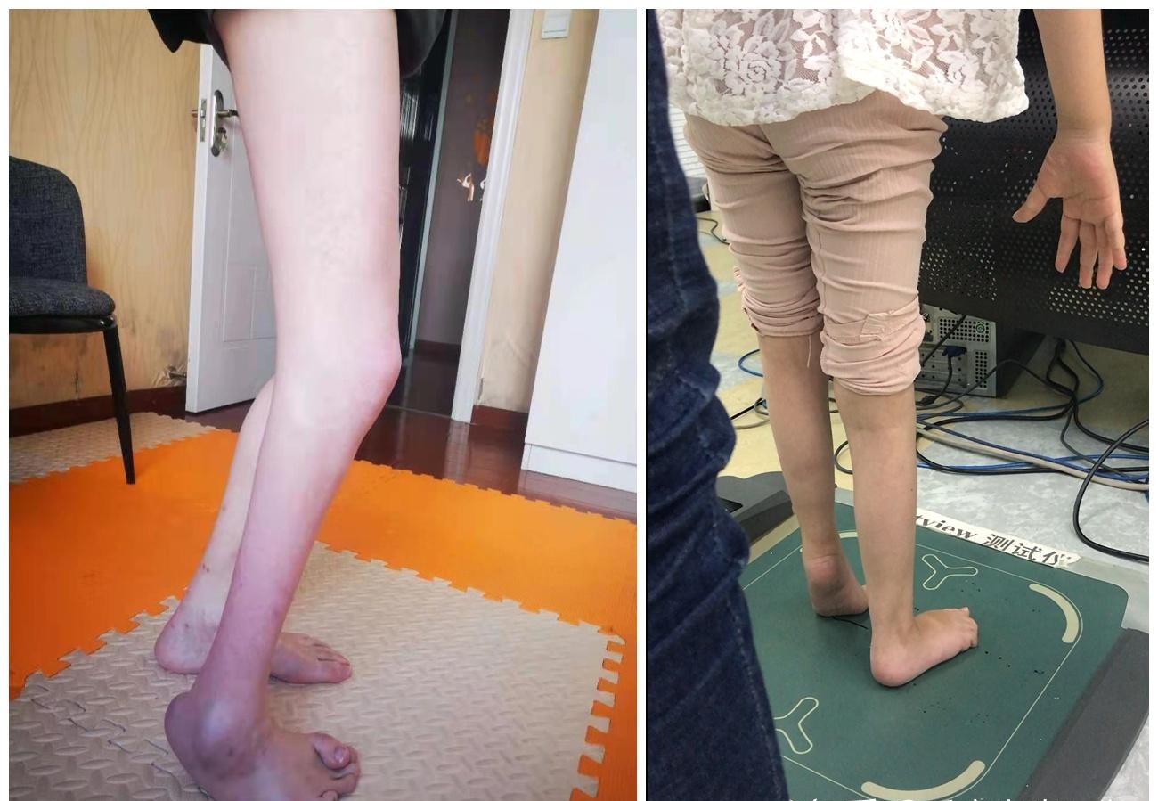 Điều trị bàn chân khoèo: Khi nào cần bó bột, khi nào cần phẫu thuật?
