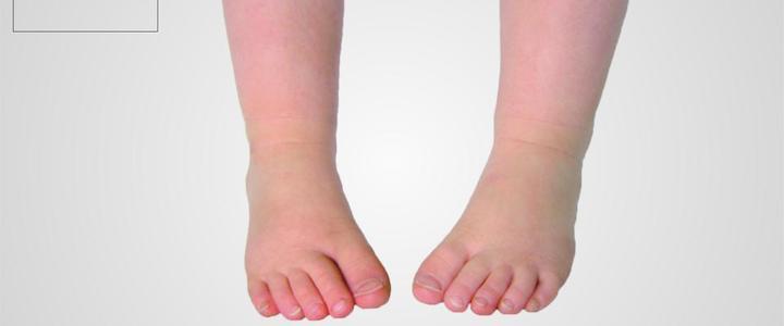 Bàn chân vẹo trong ở trẻ – Bao giờ cần can thiệp y tế?