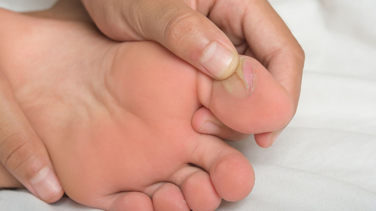 Chân trẻ em bị phồng rộp và trầy xước do đi giày không đi tất vào mùa hè.