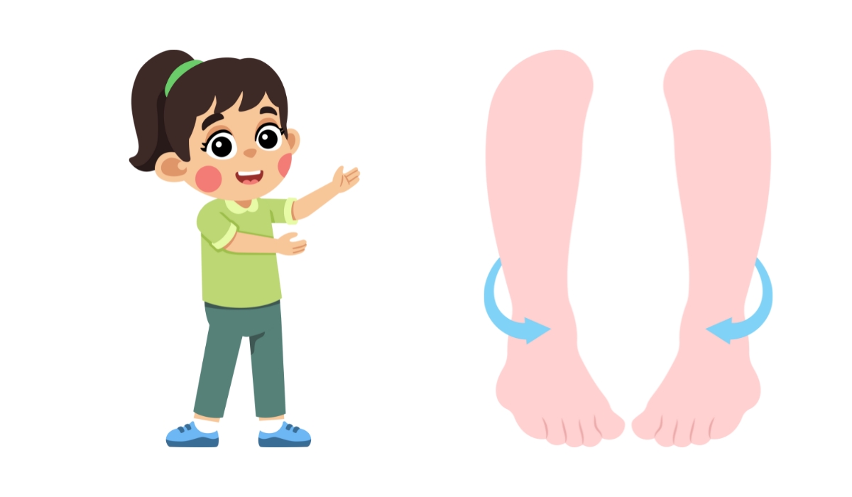 Hình ảnh một trẻ em đứng với đôi chân bị biến dạng thành hình chữ O, cho thấy tình trạng chân vòng kiềng. Bàn chân và đầu gối của trẻ không thẳng hàng, điều này có thể ảnh hưởng đến dáng đi và sự phát triển xương khớp