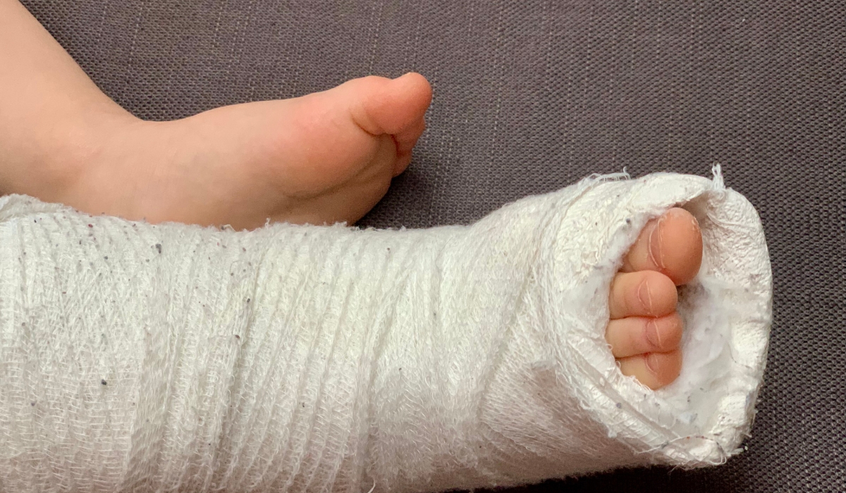 Chân của trẻ sơ sinh được bó bột, chỉ lộ ra ngón chân, thể hiện quá trình điều trị bàn chân khoèo với băng gạc trắng