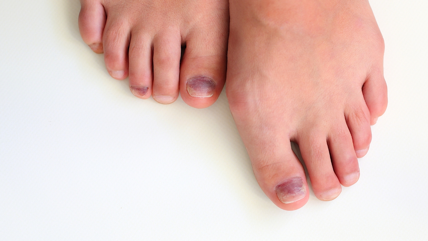 Móng chân trẻ em bị đen và tụ máu do đi giày quá chật (Runner's Toe).
