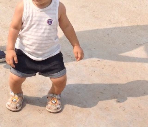 Ảnh bé đứng thẳng, hai bàn chân khép lại nhưng đầu gối tách xa nhau, minh họa tình trạng chân chữ O