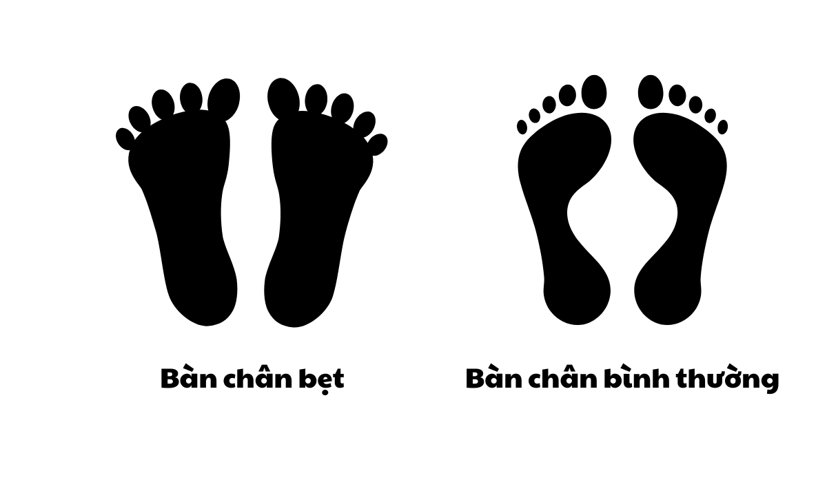 Hình ảnh so sánh 2 bàn chân cho thấy sự khác biệt giữa bàn chân bình thường và bàn chân bẹt ở trẻ