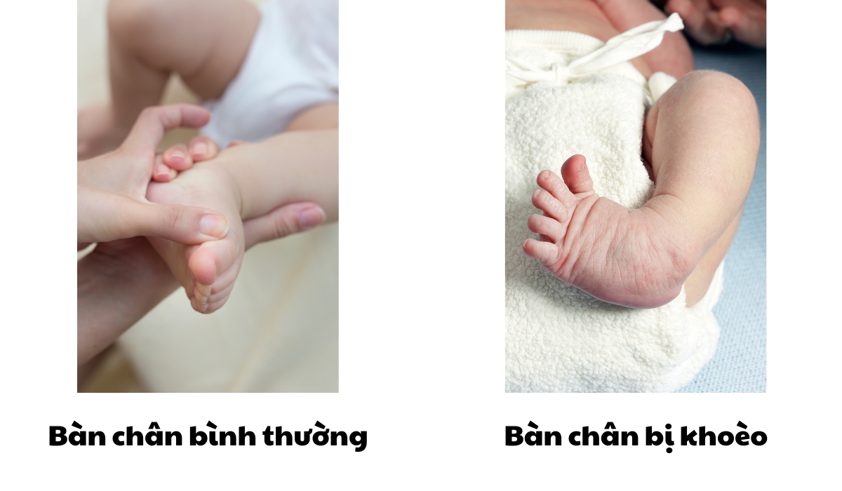 Hình ảnh so sánh bàn chân khoèo và bàn chân bình thường ở trẻ sơ sinh căn bệnh bàn chân bẹt ở trẻ em