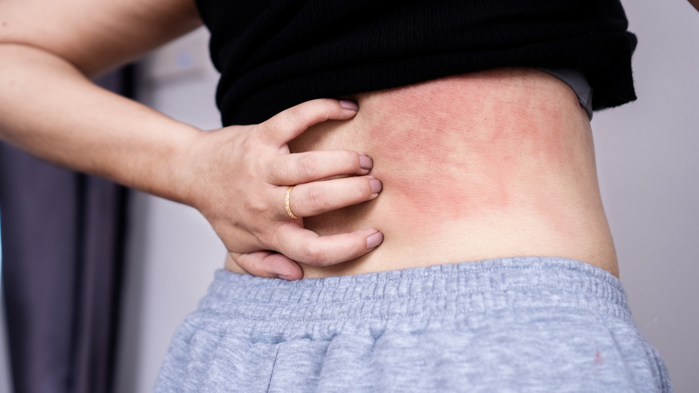 rẻ sơ sinh bị viêm da tiếp xúc nổi mẩn đỏ do dị ứng hương liệu trong nước xả vải.