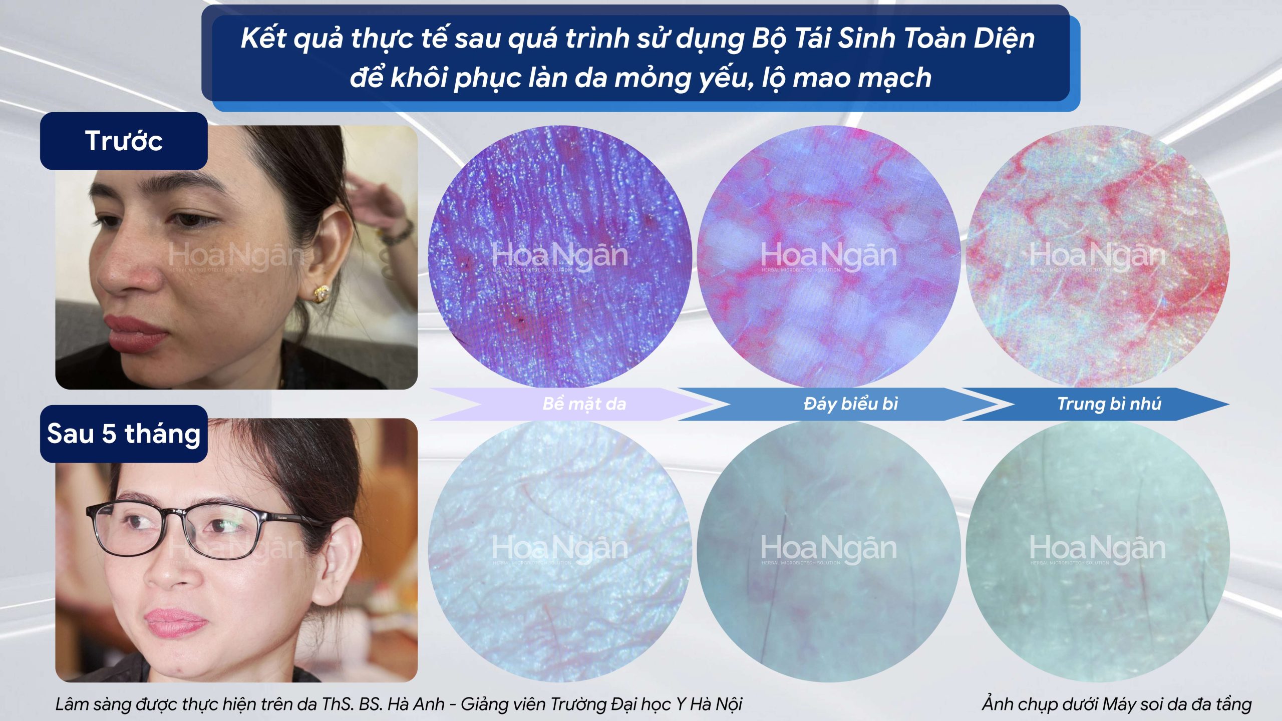 Hiệu quả từ khách hàng sử dụng Mỹ phẩm vi sinh Hoa Ngân