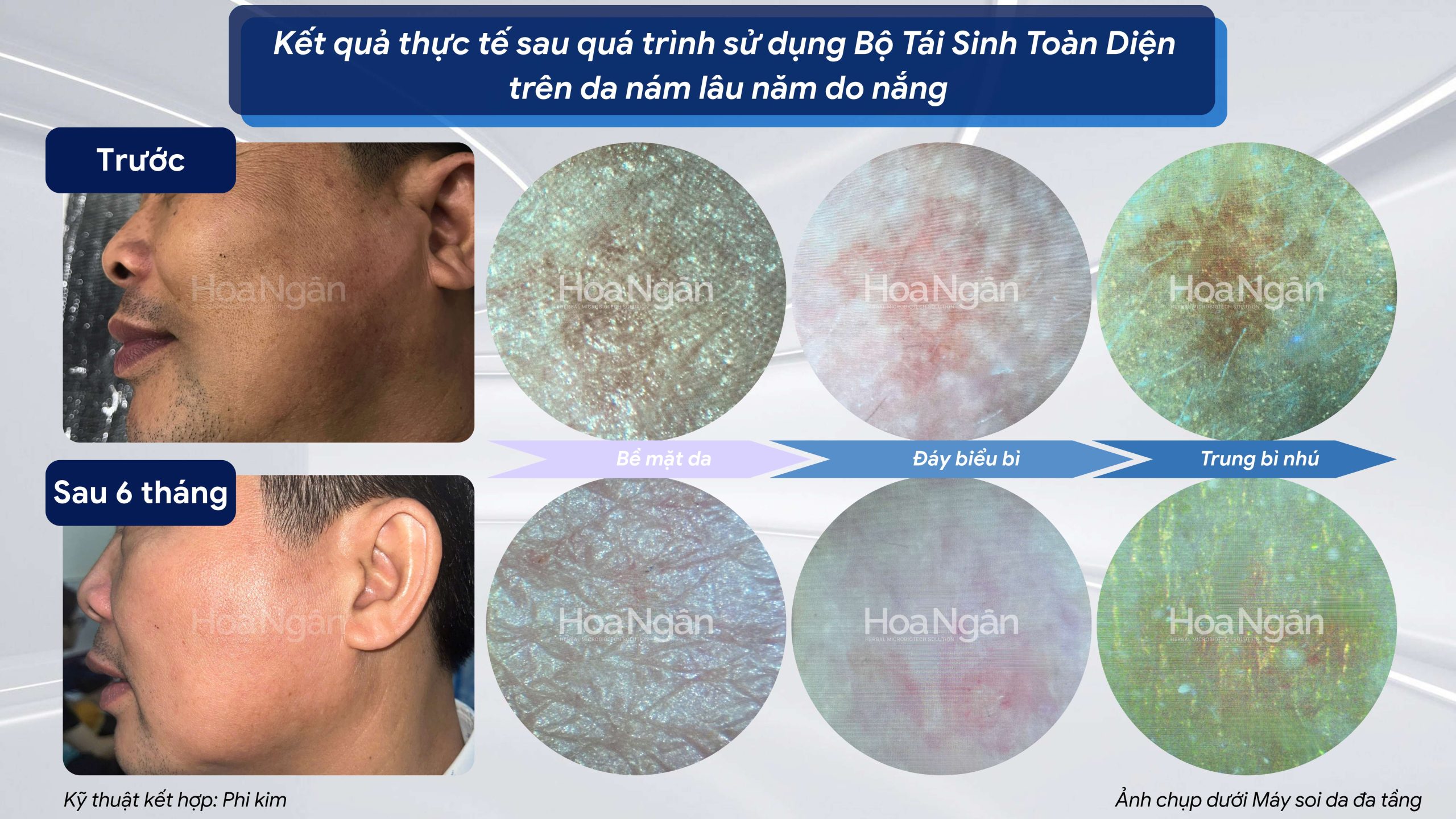 Hiệu quả từ khách hàng sử dụng Mỹ phẩm vi sinh Hoa Ngân