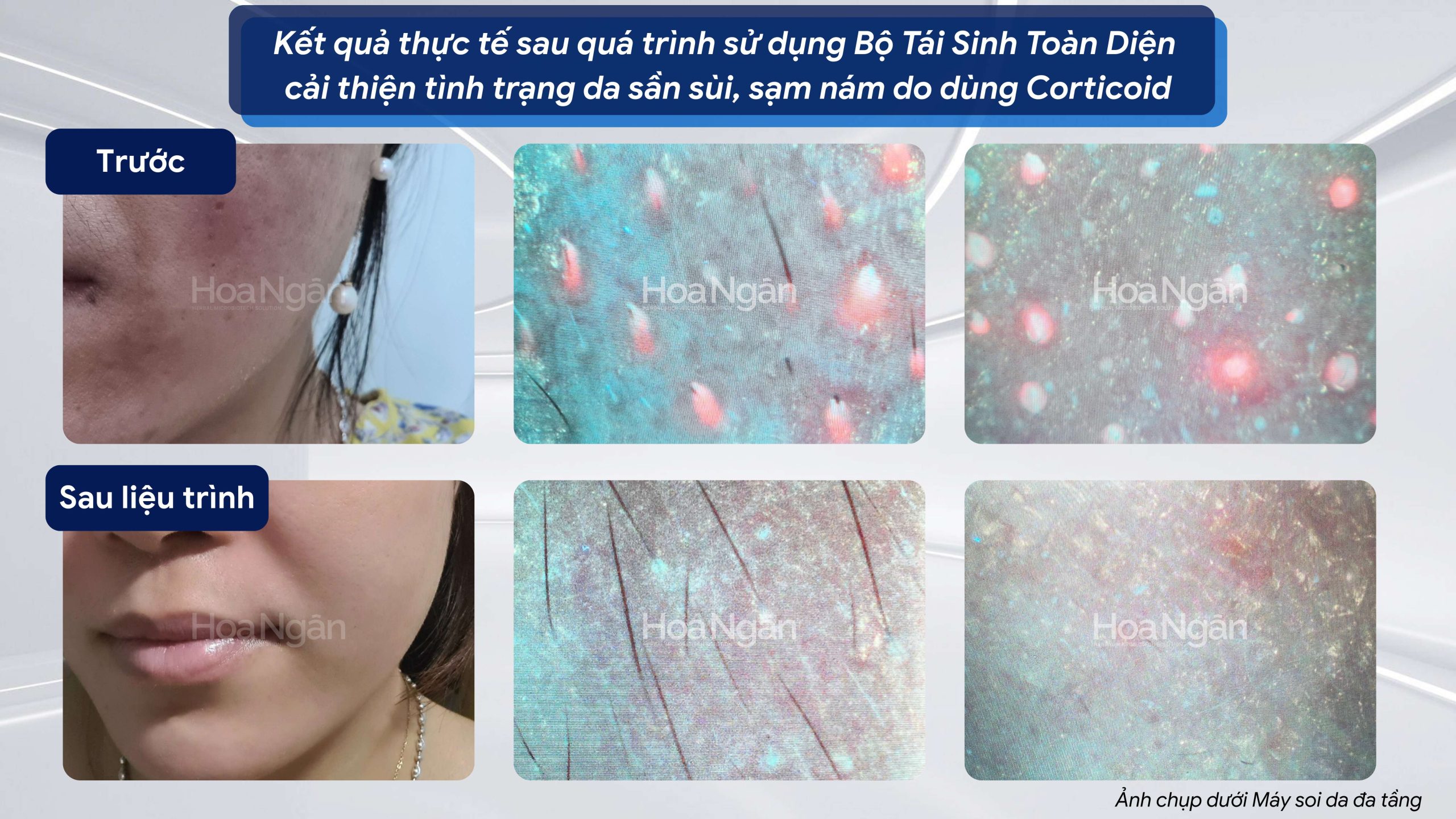 Hiệu quả từ khách hàng sử dụng Mỹ phẩm vi sinh Hoa Ngân