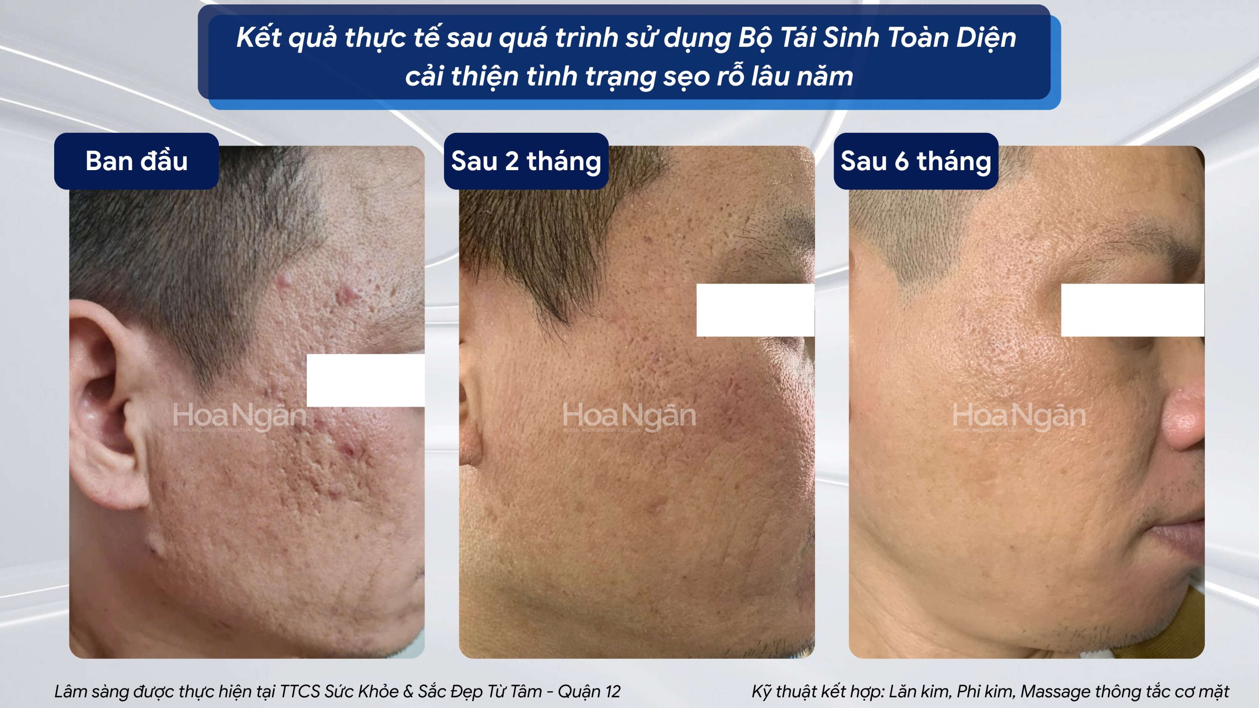 Hiệu quả từ khách hàng sử dụng Mỹ phẩm vi sinh Hoa Ngân