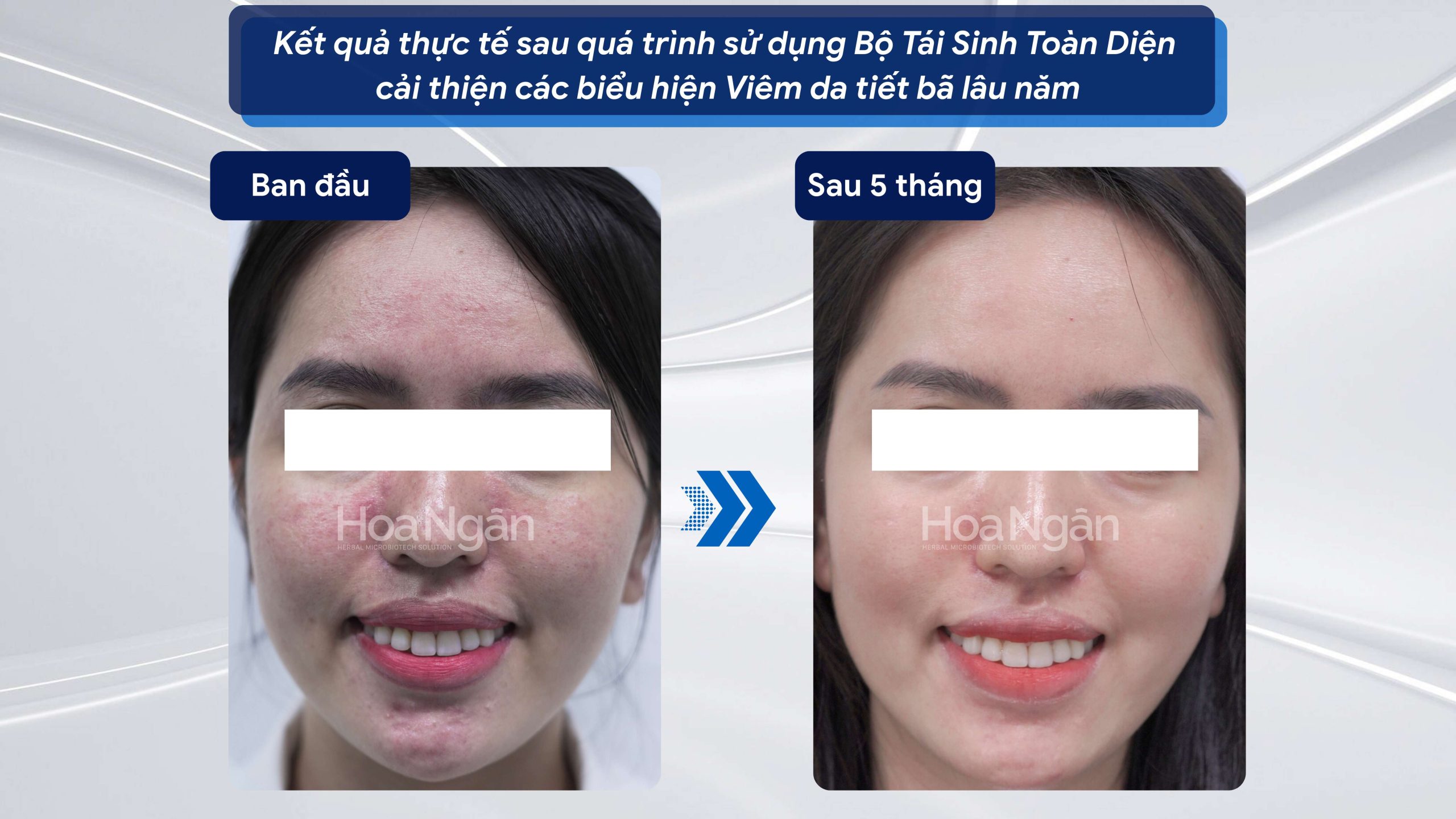 Hiệu quả từ khách hàng sử dụng Mỹ phẩm vi sinh Hoa Ngân