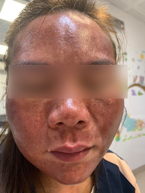 Hậu quả do dùng mỹ phẩm không chính hãng