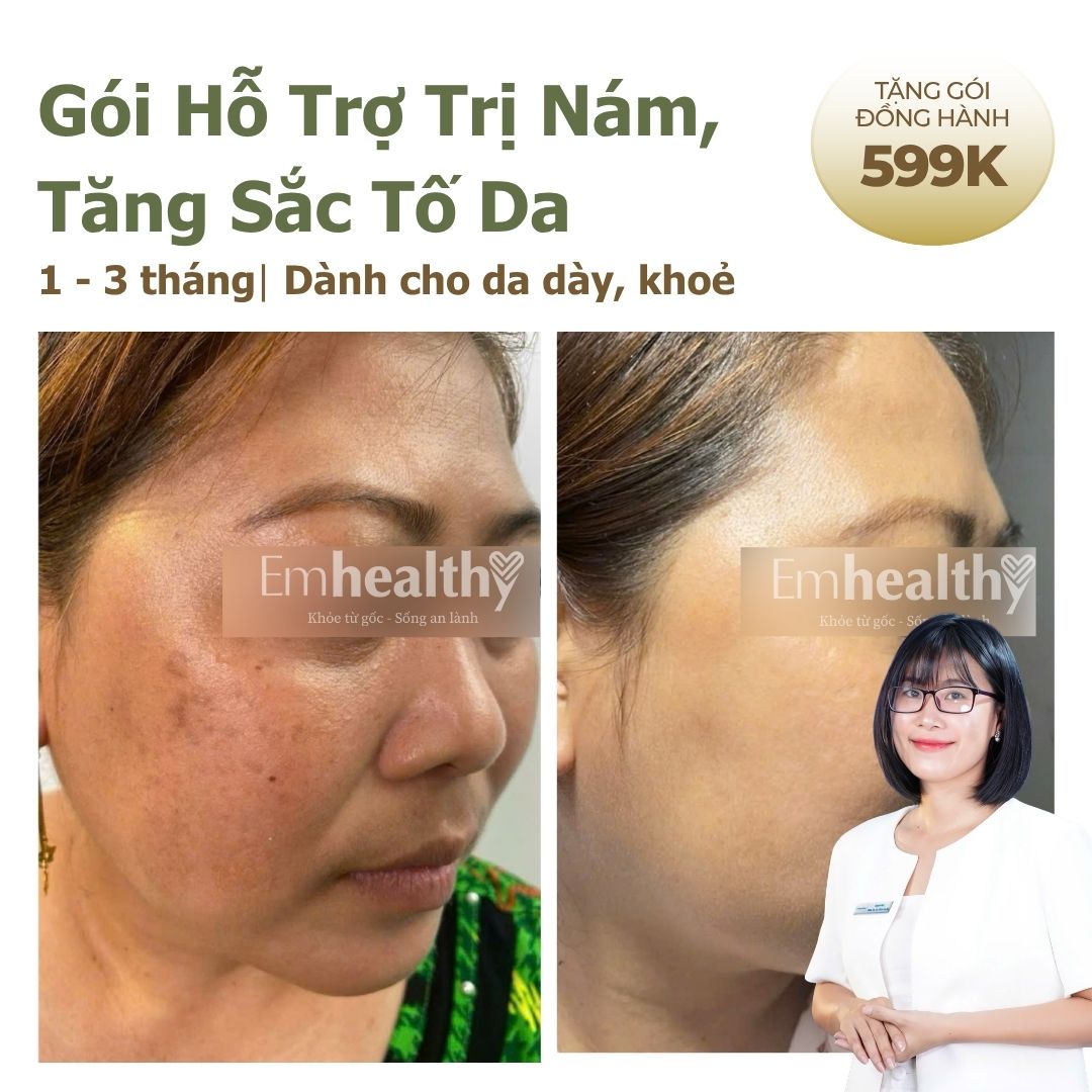 Gói Hỗ Trợ Điều Trị Nám 1 - 3 tháng| Dành cho da dày khoẻ (HLV làn da đồng hành 1:1)