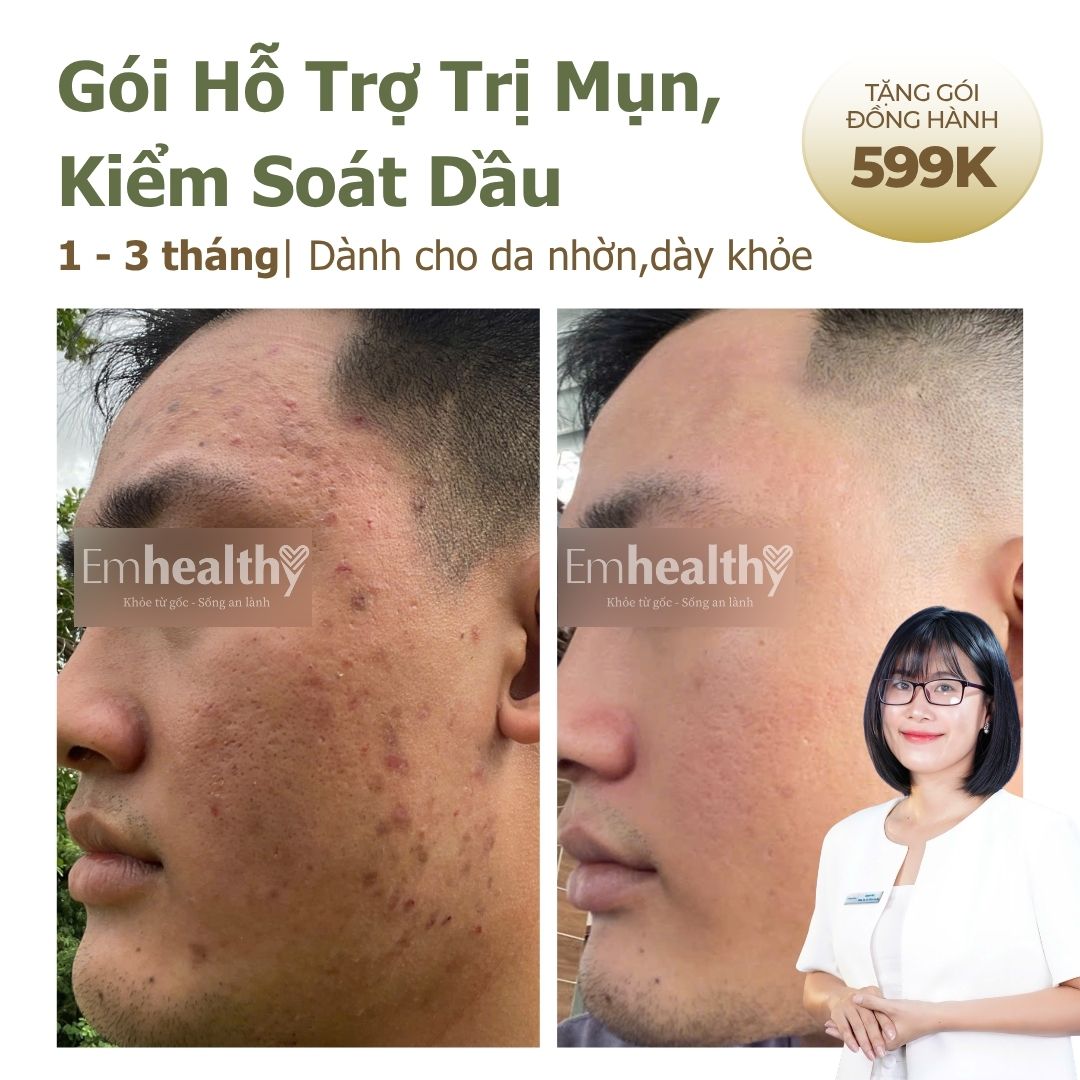 Gói Hỗ Trợ Điều Trị Mụn và Kiểm Soát Dầu 1 - 3 tháng| Dành cho da dày, khỏe (có chuyên viên theo dõi 1:1)