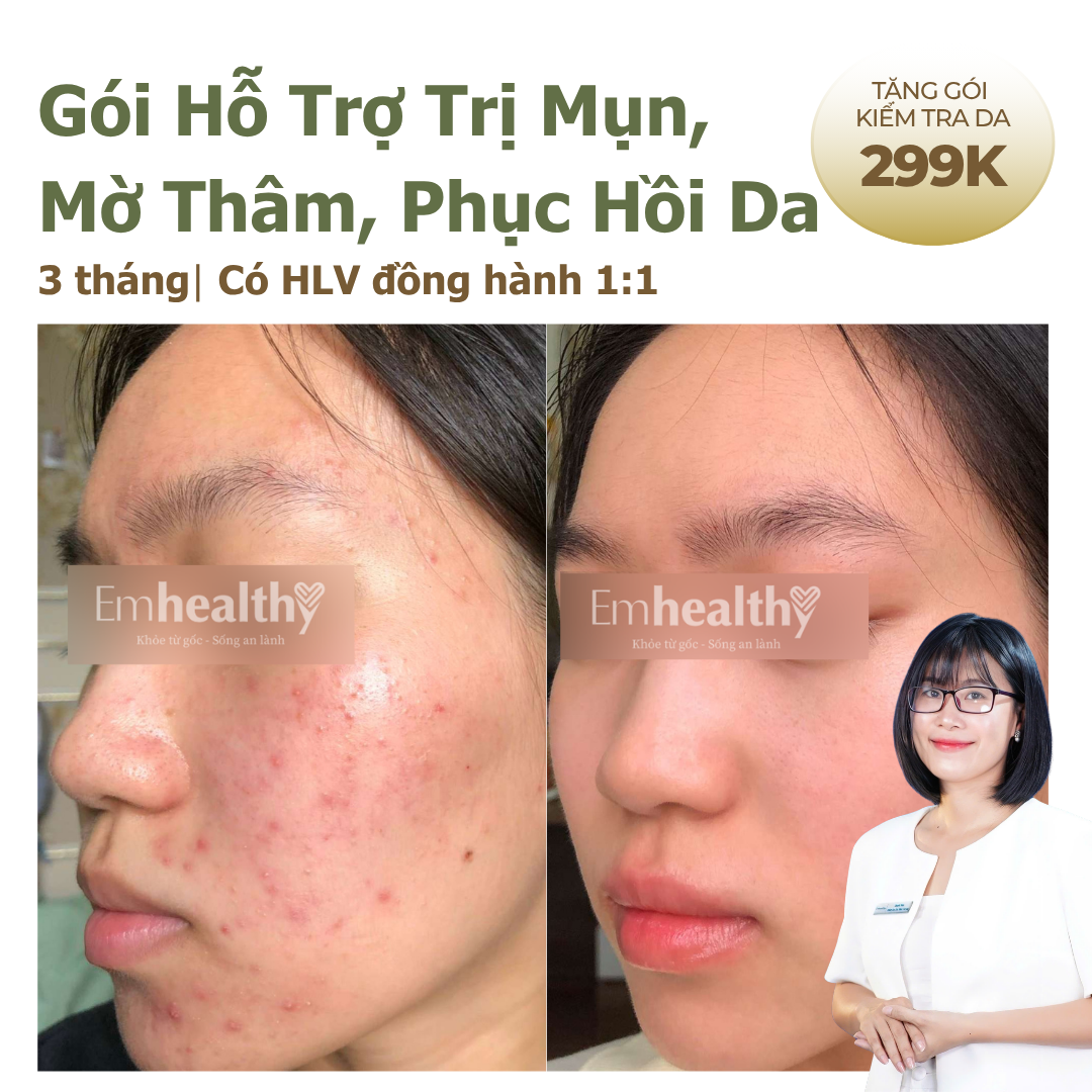 Gói Hỗ Trợ Điều Trị Mụn & Phục Hồi Nền Da 3 tháng tại nhà | có HLV sức khoẻ làn da đồng hành 1:1