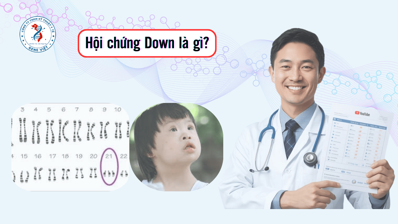 Xét Nghiệm Sàng Lọc Phát Hiện Hội Chứng Down Ở Giai Đoạn Sớm