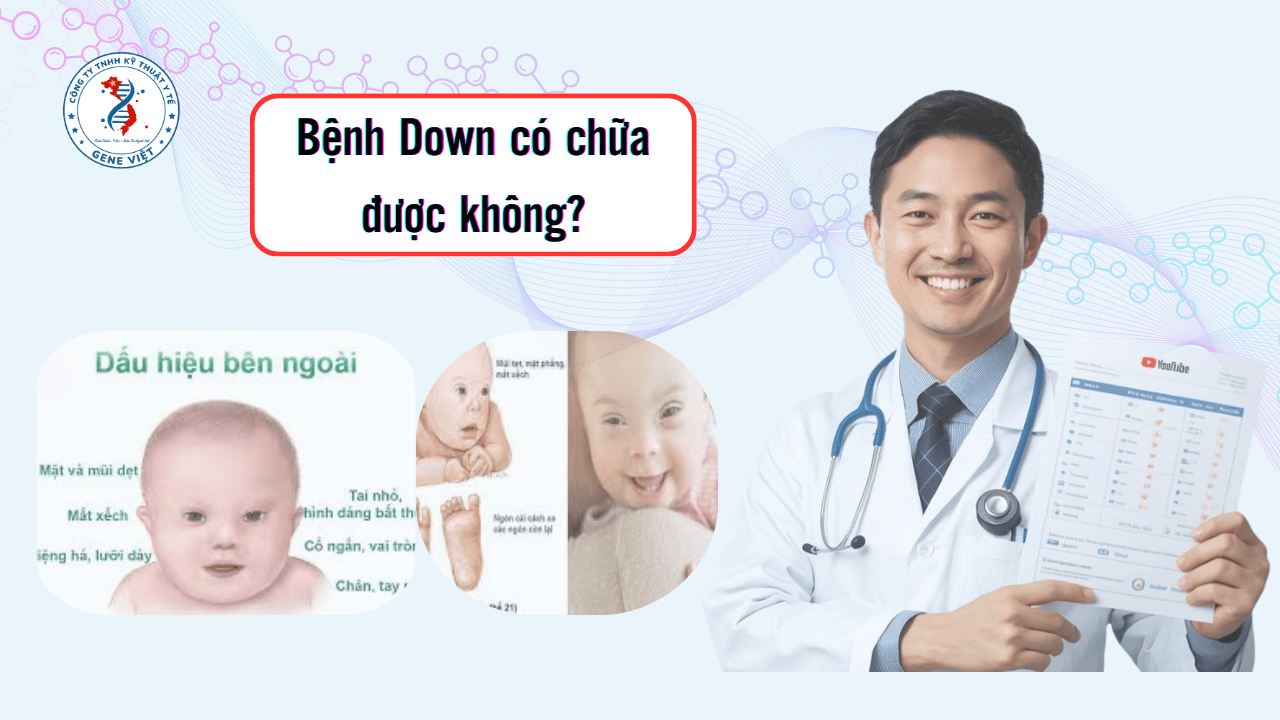 Bệnh Down Có Chữa Được Không? Cách Chăm Sóc Trẻ Mắc Hội Chứng Down