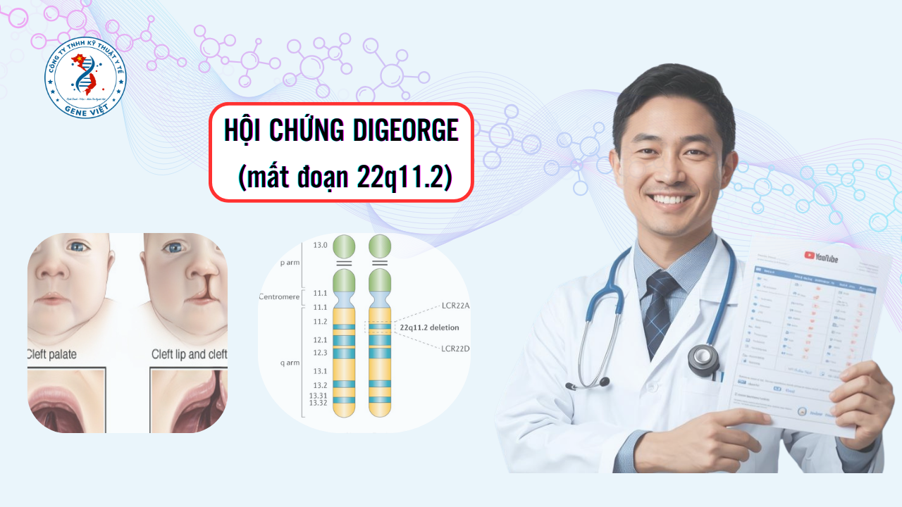 Hội chứng DiGeorge là gì?