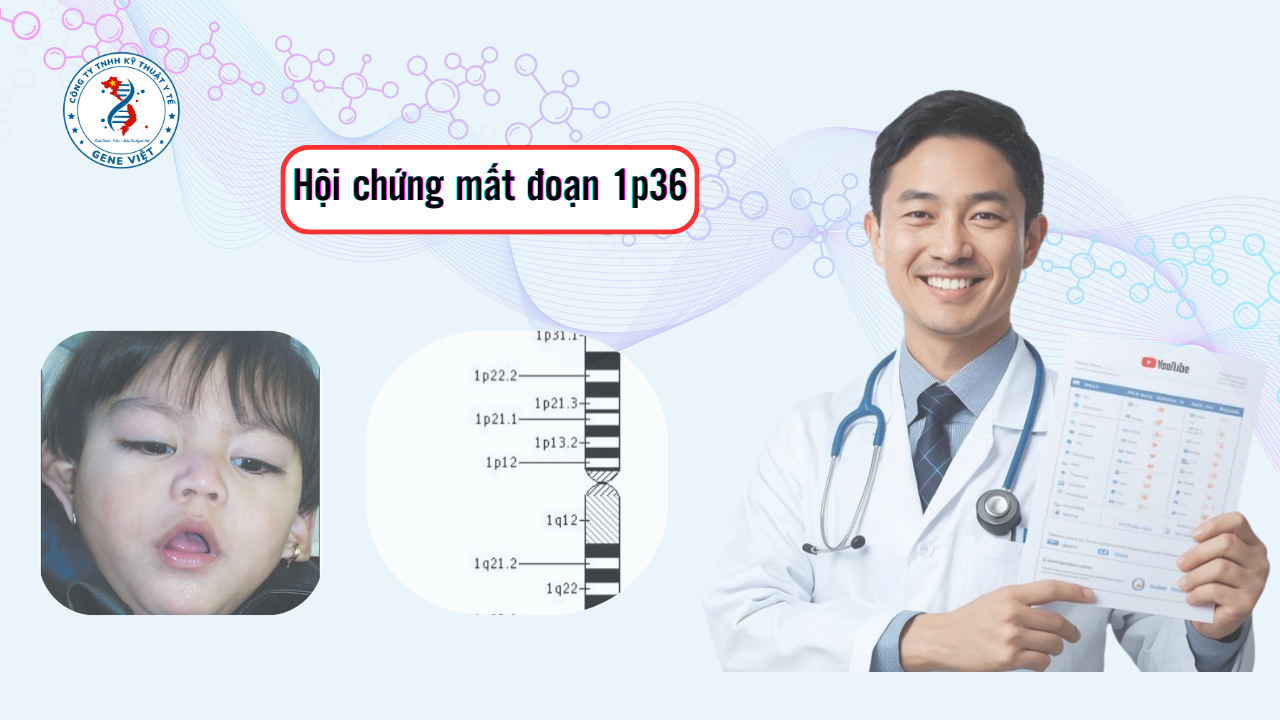 Hội Chứng Mất Đoạn 1p36: Dấu Hiệu, Chẩn Đoán & Quản Lý